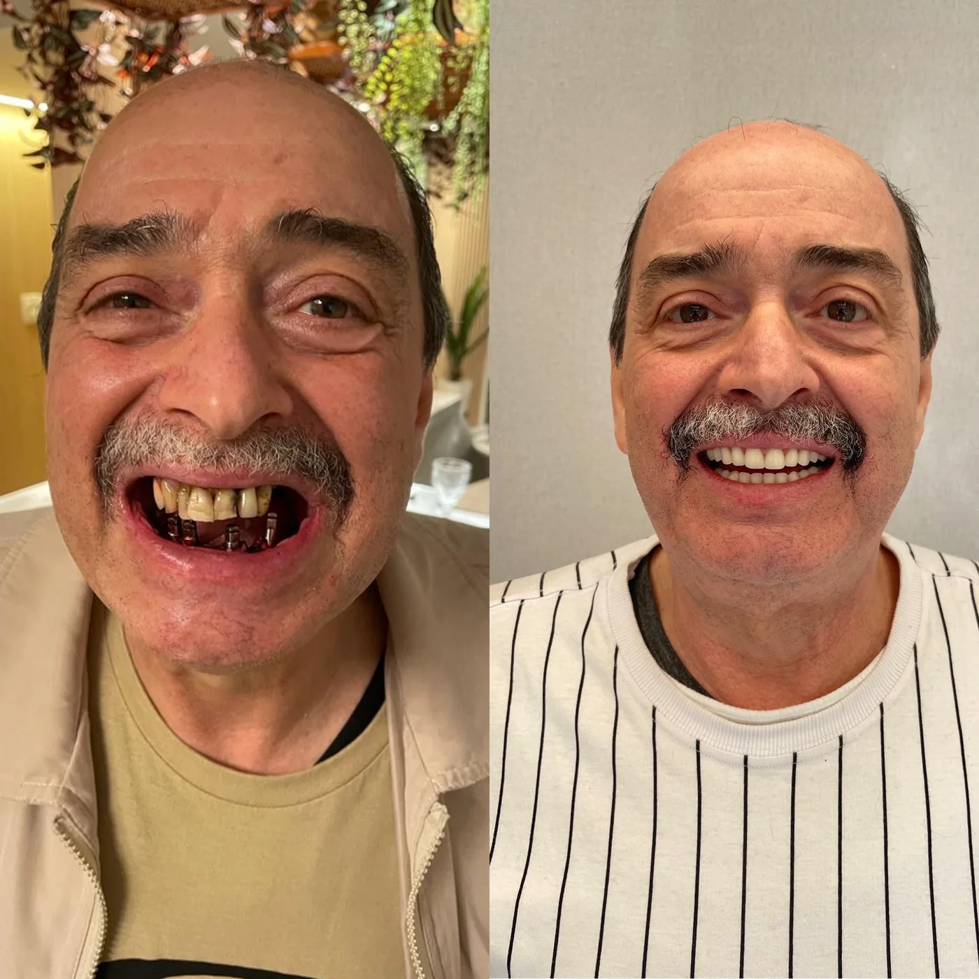 Paciente antes e depois de uma reabilitação oral completa no Instituto Jacqueline Poli